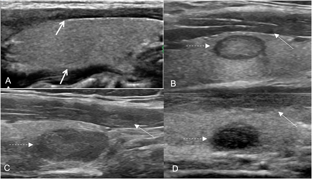 Collage of four ultrasound images. Arrows point to the hypoechoic nodules in different degrees.