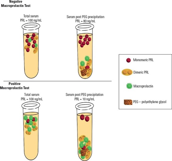 Schematic representation of macroprolactin testing using polyethylene glycol (PEG) in samples with and without macroprolactinemia. Schematic representation of macroprolactin testing using polyethylene glycol (PEG) in samples with and without macroprolactinemia.