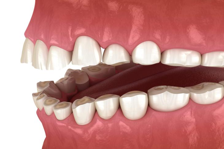 Uma mandíbula em 3D mostrando os dentes. Fundo branco, mandíbula rosa e brilhante, dentes em tom de pérola e desgastados por causa do bruxismo.
