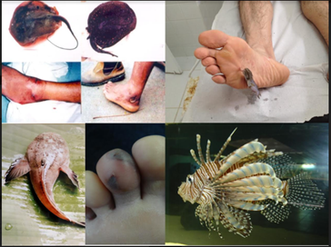 Colagem de fotos. Três fotos de pacientes que sofreram envenenamento por peixes: duas mostram os pés machucados e uma mostra o ferrão ainda preso na sola do pé. Duas fotos de peixes diferentes.