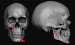 Does facial skeletal asymmetries have the same components in Class I, II, and III individuals?