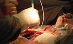 Close-up photo of a surgery. One hand holds a cylindrical instrument similar to a thick needle, it has a thread at the top end. Another hand holds a pair of scissors. Both instruments are aimed at an opening in a person's body.