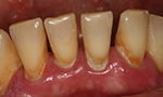 Fotografia mostrando paciente com periodontite